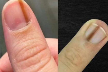 Linija ant nago: ką ji reiškia ir kada reikia sunerimti? Nuotraukos: socialiniai tinklai