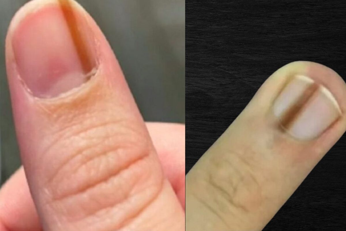 Pastebėję tokią liniją ant nago, nedelsdami kreipkitės į gydytoją – tai gali išgelbėti jūsų gyvybę