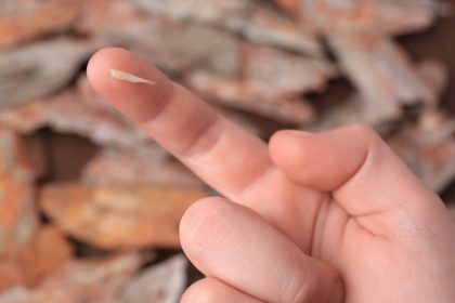 Kaip pašalinti rakštį be skausmo: veiksmingi būdai namuose