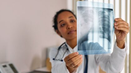 Kaip plaučiai atsigauna metus rūkyti? Ką rodo nauji duomenys apie atsinaujinimą ir riziką